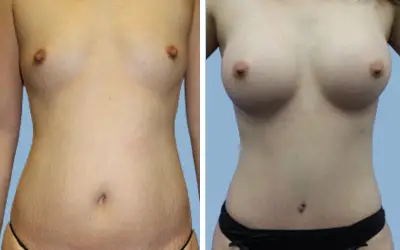 Before and After